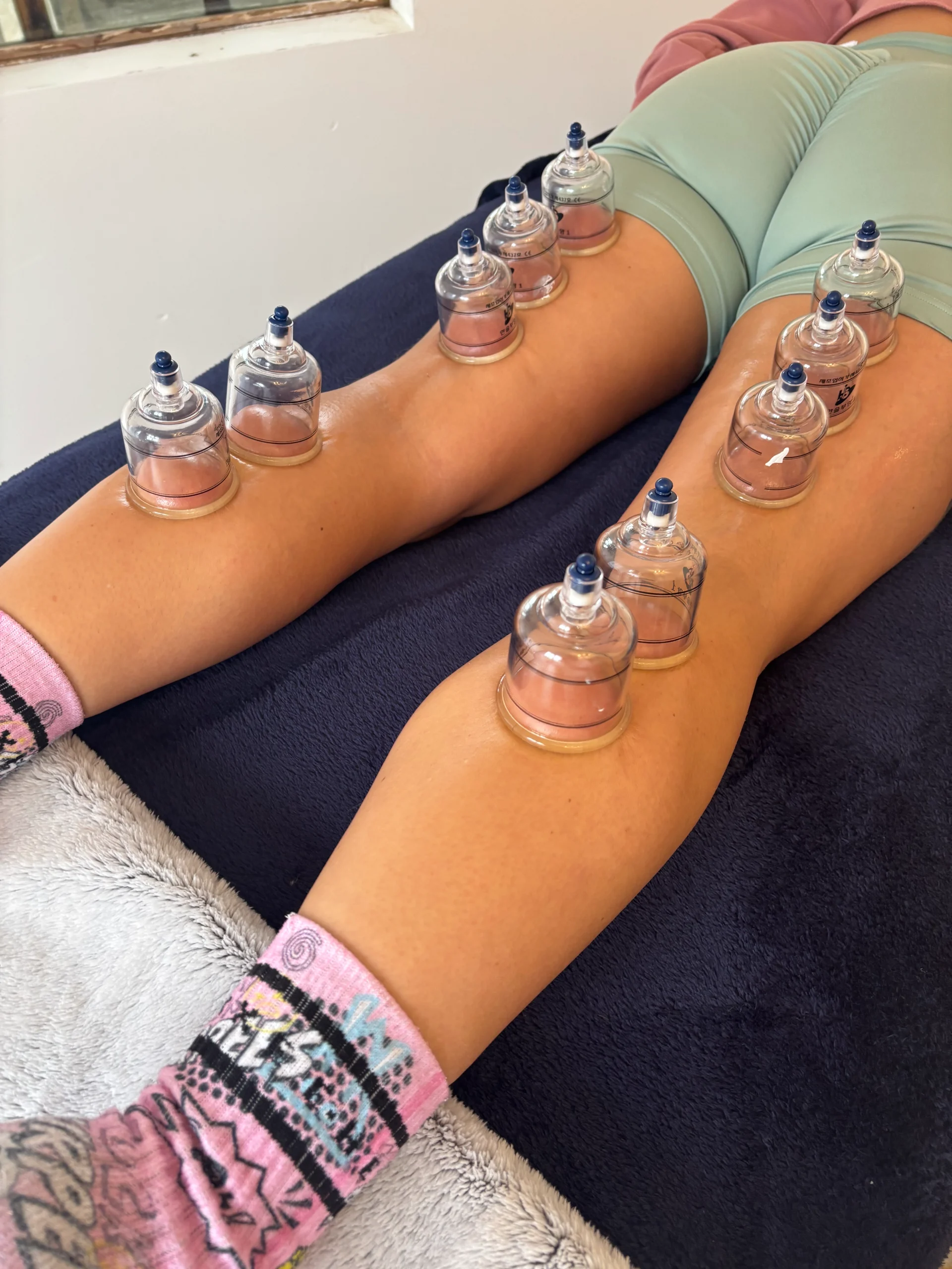 Cupping therapy on legs – A person receiving cupping therapy on both legs.