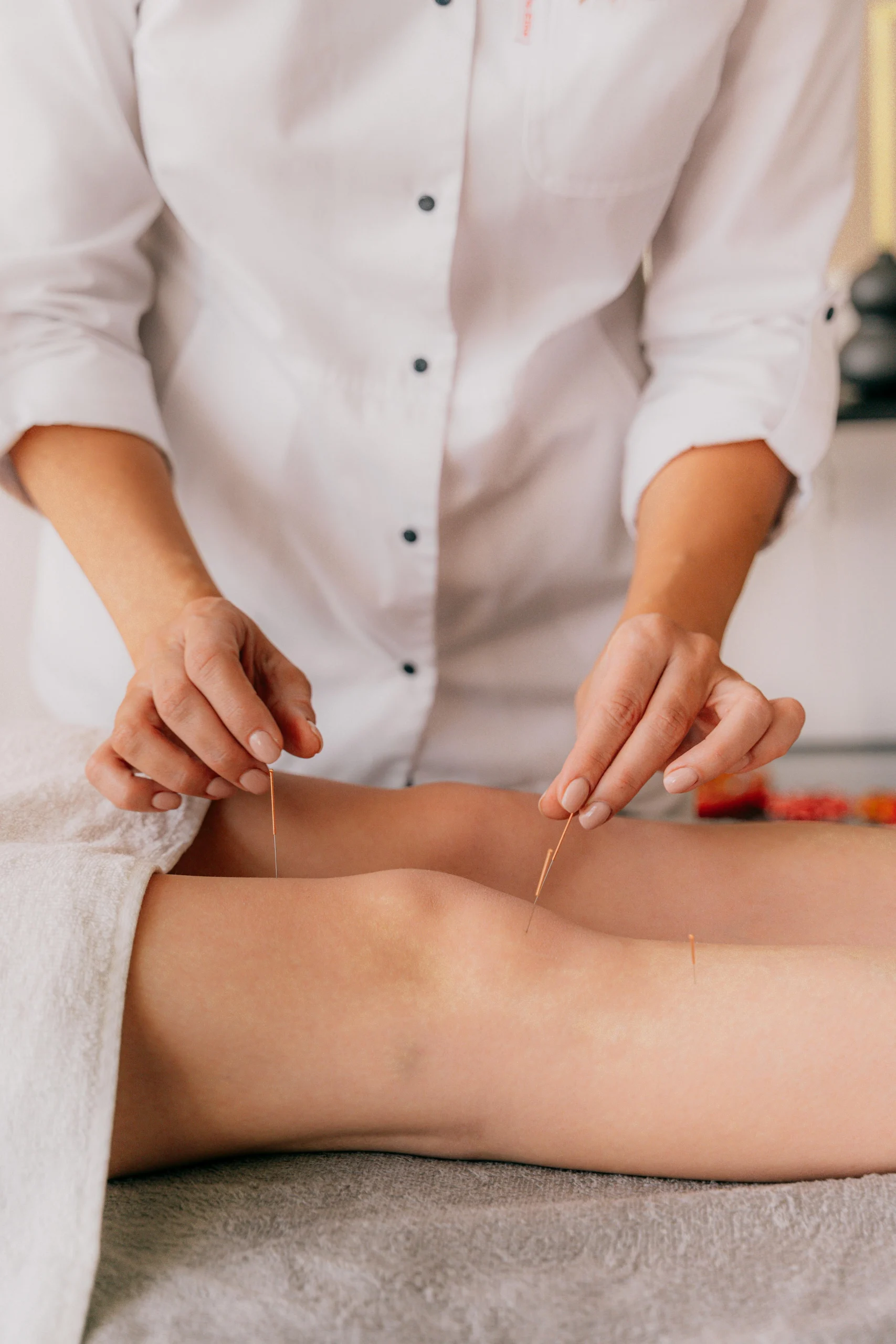 Practitioner performing acupuncture – Professional applying acupuncture needles into a patient's leg.